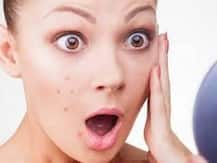 पिंपल्स से बचने के लिए इन बुरी आदतों को छोड़ें!