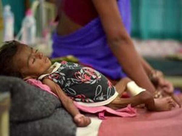 Chhattisgarh: Average malnutrition rates plunge considerably in children Chhattisgarh: Average malnutrition rates plunge considerably in children