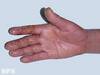 Patients with hand disabling Dupuytren\'s can now hope for a cure