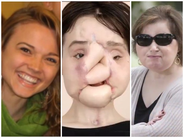 21-year-old suicide survivor undergoes historic face transplant 21-year-old suicide survivor undergoes historic face transplant