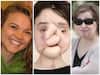 21-year-old suicide survivor undergoes historic face transplant
