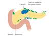 Blocking digestive hormone prevents pancreatic cancer