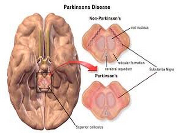 Insulin resistance may go undetected in non-diabetics with Parkinson's Insulin resistance may go undetected in non-diabetics with Parkinson's