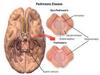 Insulin resistance may go undetected in non-diabetics with Parkinson\'s