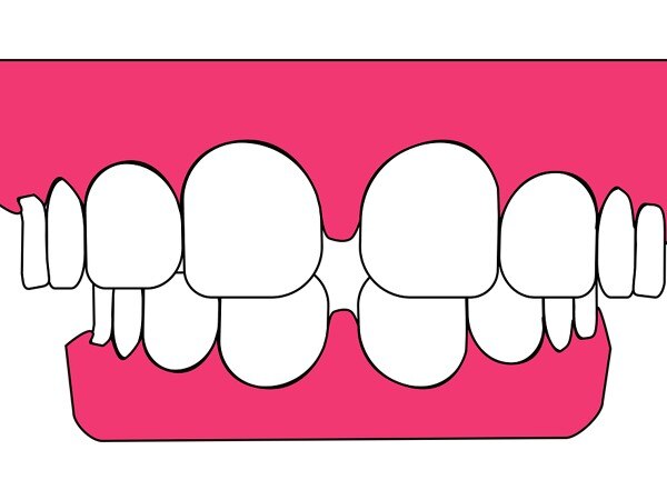 Dental X-rays can reveal vitamin D deficiency Dental X-rays can reveal vitamin D deficiency