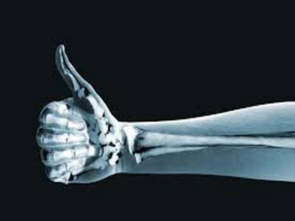 Steroid jabs for hip arthritis may risk bones Steroid jabs for hip arthritis may risk bones