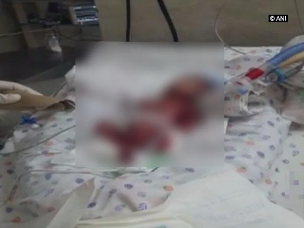 Delhi: Newborn, declared dead by hospital, found alive later Delhi: Newborn, declared dead by hospital, found alive later
