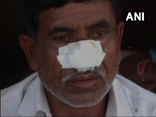 Kannauj: Man bites off brother's nose after denied money for alcohol Kannauj: Man bites off brother's nose after denied money for alcohol