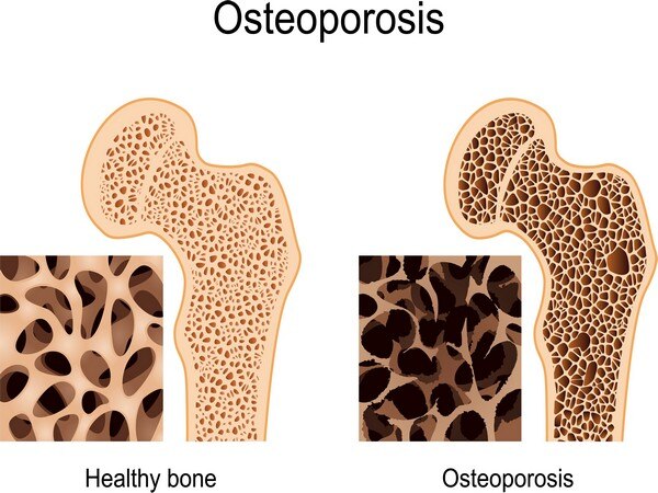 Clearing the myths about osteoporosis Clearing the myths about osteoporosis