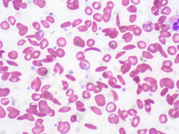 All you need to know about sickle-cell disease All you need to know about sickle-cell disease