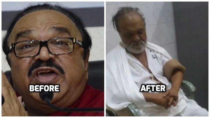 NCP leader Chhagan Bhujbal's BEFORE & AFTER picture goes viral NCP leader Chhagan Bhujbal's BEFORE & AFTER picture goes viral