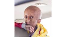Nihal Bitla, the face of Progeria in India, passes away at 15