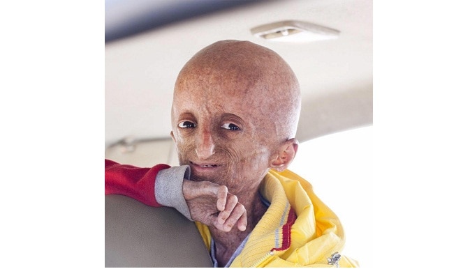Nihal Bitla, the face of Progeria in India, passes away at 15 Nihal Bitla, the face of Progeria in India, passes away at 15