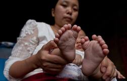 China: Meet Hong Hong, boy born with 31 fingers and toes!