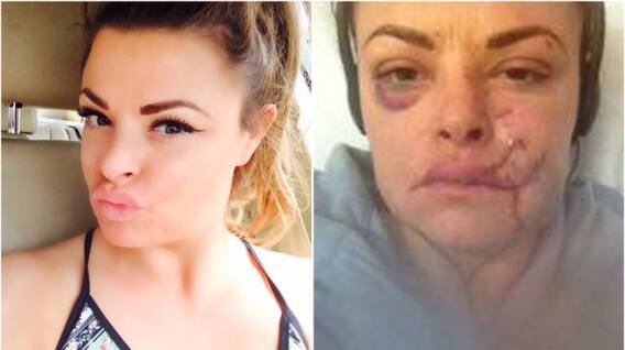 Watch: Model attacked with glass in face, leaving her needing 50 stitches