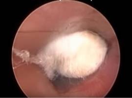 Graphic video: This is why you shouldn't push a cotton bud too far into your ear Graphic video: This is why you shouldn't push a cotton bud too far into your ear