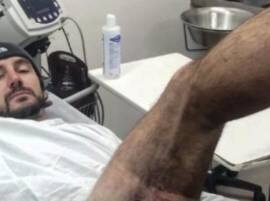 Report: iPhone 6 of Apple explodes, leaves man with third-degree burns Report: iPhone 6 of Apple explodes, leaves man with third-degree burns Report: iPhone 6 of Apple explodes, leaves man with third-degree burns