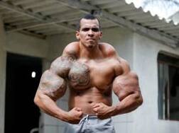 This Brazilian Bodybuilder Injects 'Mineral Oil' Into Muscles To Get Hulk Like Physique