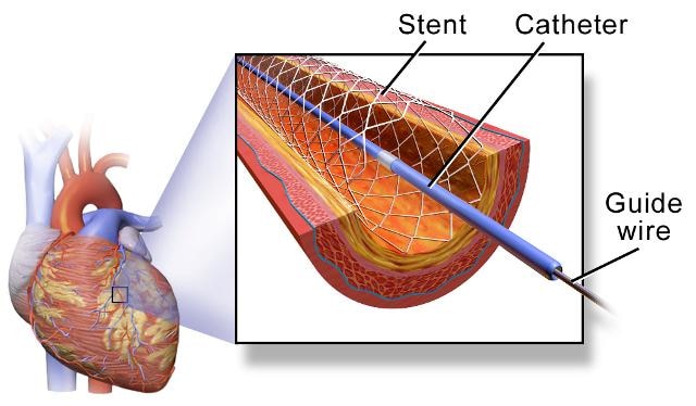 Heart of the matter: NDA Govt slashes stent prices Heart of the matter: NDA Govt slashes stent prices