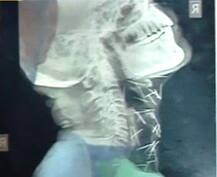 Viral Sach: Does a man have 75 pins in his body?