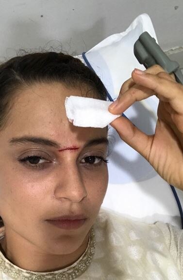Kangana 'thrilled' to have battle scar on face! Kangana 'thrilled' to have battle scar on face!