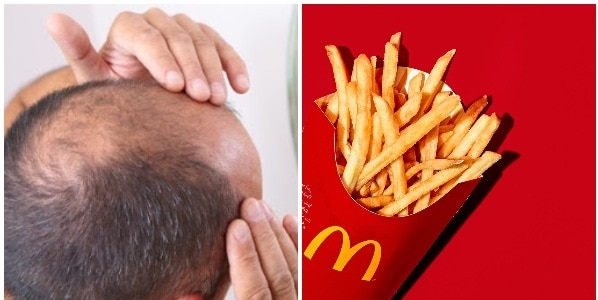Study Says Chemical In McDonald’s French Fries Might Cure Baldness! Twitter Can’t Keep Calm Study Says Chemical In McDonald's French Fries Might Cure Baldness! Twitter Can't Keep Calm