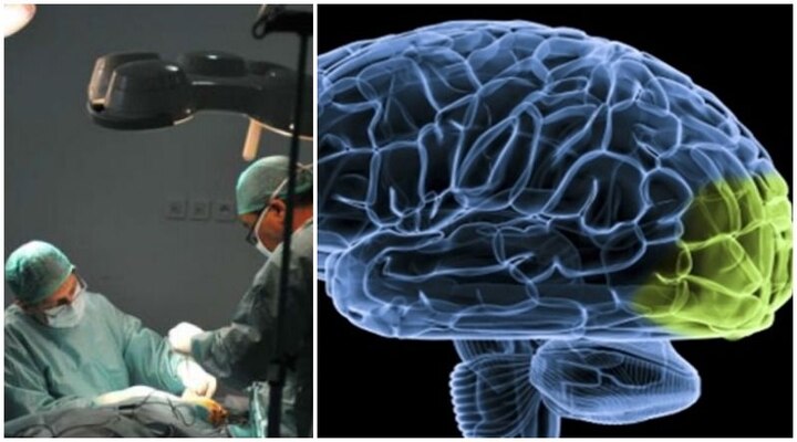 World’s largest brain tumour removed in Mumbai hospital World's largest brain tumour removed in Mumbai hospital