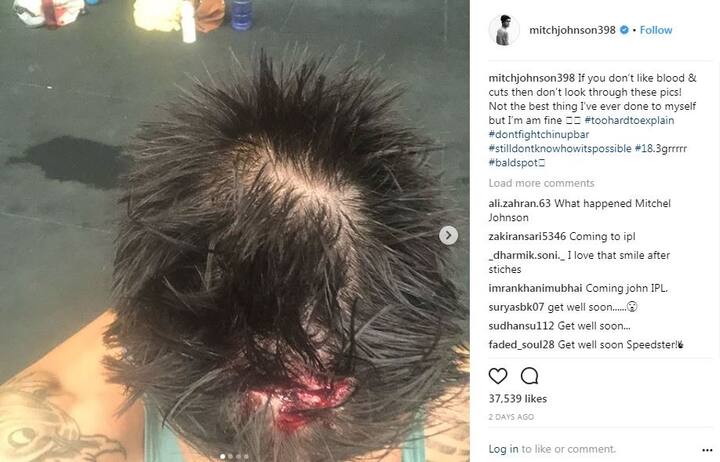 The 36-year-old pacer shared the gory pictures on his instagram account with the caption“If you don’t like blood & cuts then don’t look through these pics!”