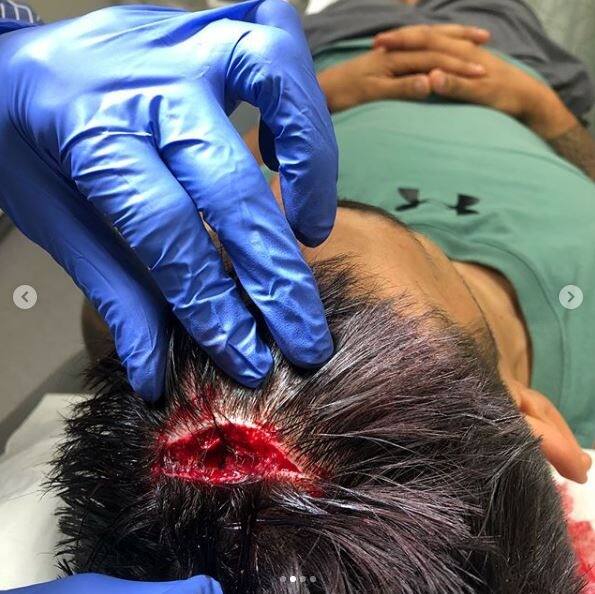 The second picture shared by Johnson reveals the seriousness of the wound.