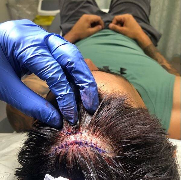 Johnson required 16 stitches on his scalp for the bleeding to stop.