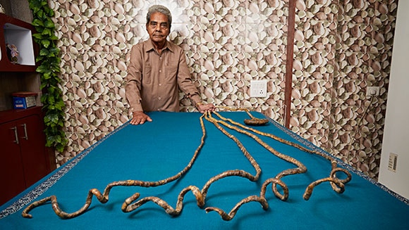 Bizarre! Guinness World Record holder to finally cut his fingernails after 66 years Bizarre! Guinness World Record holder Shridhar Chillal to finally cut his fingernails after 66 years
