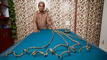 Shridhar Chillal\'s hand permanently handicapped for not cutting nails for 66 years