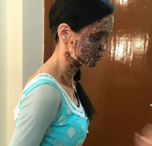 Soon their fan clubs shared these pics of Monaya's bruised face on social media revealing details of their act, we wonder if the couple will be performing on the iconic song from 'Satyam Shivam Sundram'.