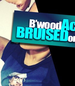 Oh! A popular Bollywood actress bruised her arm during action scene shoot; Film by famous director releasing soon! Oh! A popular Bollywood actress bruised her arm during action scene shoot; Film by famous director releasing soon!