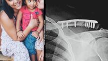 TV actress Shweta Salve undergoes shoulder surgery; Shares X-Ray with screws fixing fracture!
