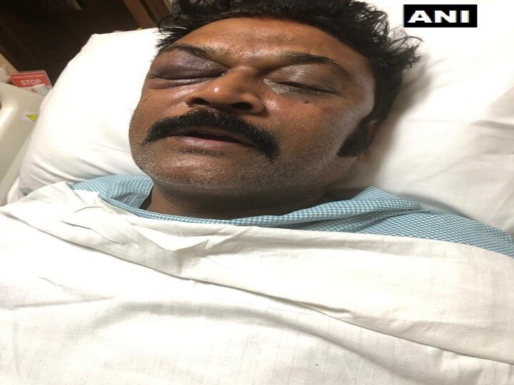 Karnataka: Picture of Congress MLA Anand Singh's bruised face with swollen and blackened eyes Karnataka: Picture of Congress MLA Anand Singh's bruised face with swollen and blackened eyes