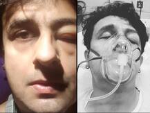 Sonu Nigam shares his hospital pics from ICU with one eye swollen! Reveals sea food caused allergy!