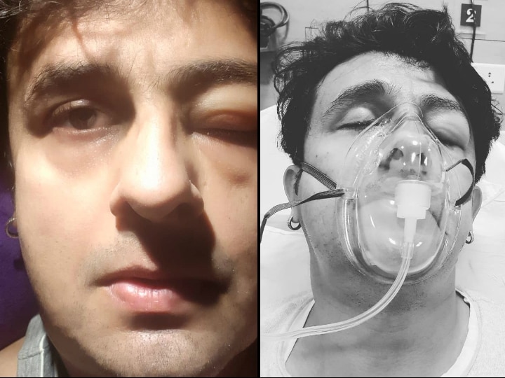 Sonu Nigam shares his hospital pics from ICU with one eye swollen! Reveals sea food caused allergy! Sonu Nigam shares his hospital pics from ICU with one eye swollen! Reveals sea food caused allergy!