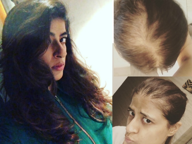 Ayushmann Khurrana's Wife Tahira Kashyap Shares Hair Loss Pics From Cancer  Fight, Says 'Cancer Has Changed My Mindset' | Tahira Kashyap Shares Hair  Loss Pics From Cancer Fight, Says- 'Cancer Has Changed