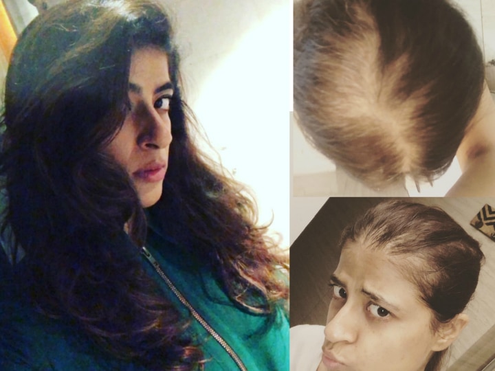 Ayushmann Khurrana's wife Tahira Kashyap shares hair loss pics from cancer fight, Says 