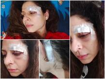 Popular TV Actress Tannaz Irani Shares PICS Of Her Injured Face Leaving Fans Worried!