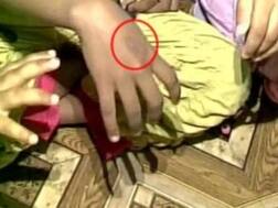 तेलंगाना में दरिंदगी: आनाथालय में बच्चों को गरम चम्मच से दागा