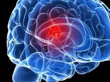 खुशखबरी! इस प्रोटीन के जरिए बढ़ता ब्रेन ट्यूमर रूक जाएगा
