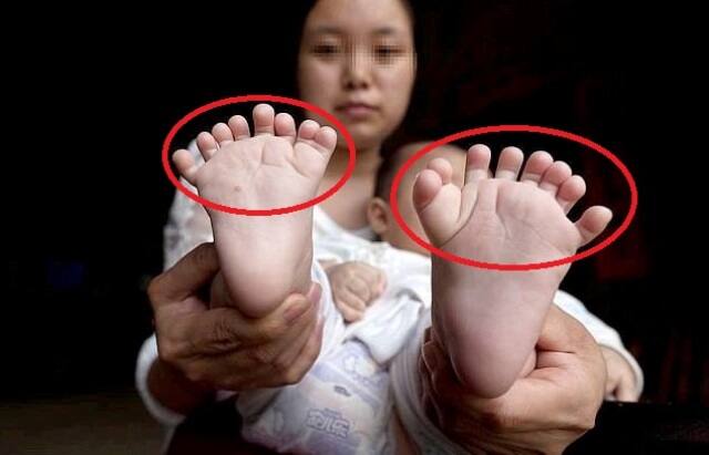 इसके साथ ही इस लड़के के पैरों में भी 10 की जगह 16 उंगलियां हैं.