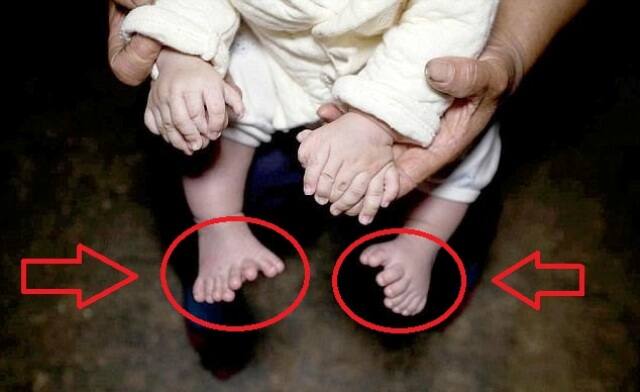खबरों के मुताबिक इस तरह का दुर्लभ मामला एक हजार में एक होता है. इसे पोलिडेक्टिलिज्म के नाम से भी जाना जाता है.