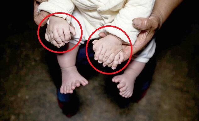 केवल इतना ही नहीं होंगहोंग नाम के इस तीन महीने के बच्चे के हाथों में अंगूठा नहीं है, बल्कि दो-दो हथेलियां हैं.