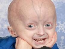 हजार में से दस बच्चे पैदा होते हैं जेनेटिक डिसऑर्डर की बीमारी के साथ