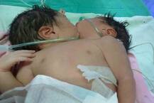 मुंबई में पैदा हुए दो सिर और तीन हाथों वाले बच्चे!