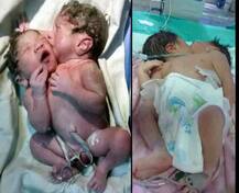 मुंबई में पैदा हुए दो सिर और तीन हाथों वाले बच्चे!