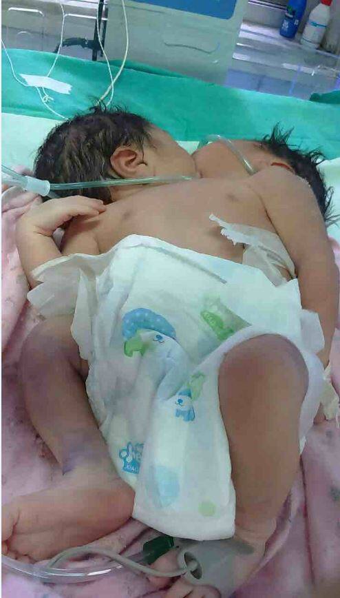  डॉक्टरों की टीम बच्चे की जांच कर रही है ताकि पता लगाया जा सके कि बच्चे का ऑपरेशन हो सकता है या नहीं. 